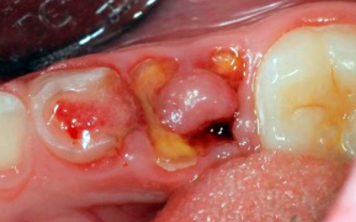 Десна в дырке зуба лечение