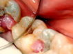 В дырке зуба выросла десна: почему так произошло и что нужно делать?