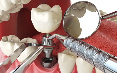 срок службы зубного импланта