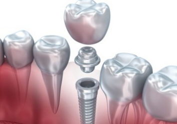 Какой на самом деле срок службы зубного импланта?
