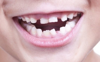 молочные зубы меняют на постоянные