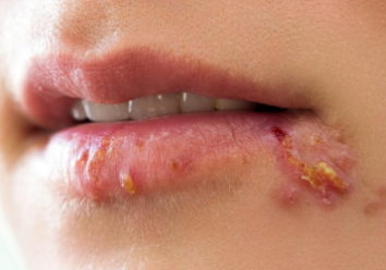 Герпес на губах: пути передачи вируса, симптомы, лечение, осложнения