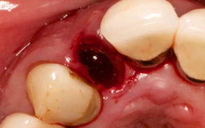 кровяной сгусток после удаления зуба фотографии