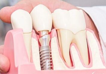 Протезирование зубов на имплантатах